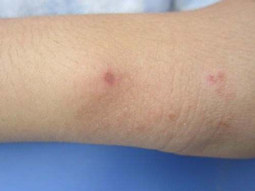 キイロスズメバチによる腕の刺傷被害（三春町）