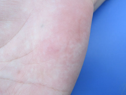 キイロスズメバチによる手の平の刺傷被害（三春町）