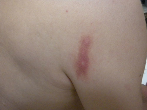 スズメバチに刺されてから２日後の症状