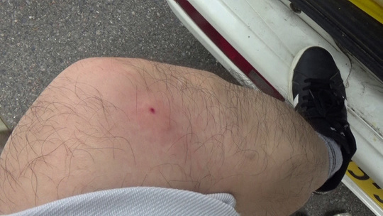 白河市でスズメバチに刺された直後