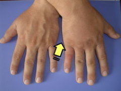 スズメバチに刺された手の平