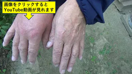 二本松市で剪定中にスズメバチに刺された手