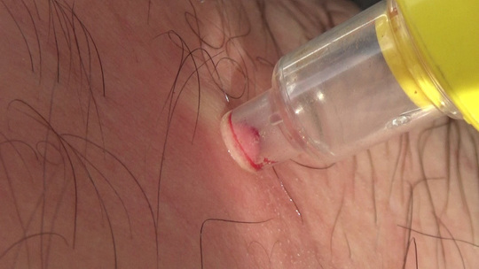 白河市でスズメバチにい刺された応急処置