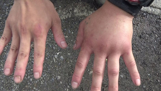 福島県中島村で生垣の剪定中にスズメバチに刺された手