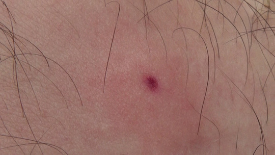 白河市でスズメバチに刺された直後の傷跡