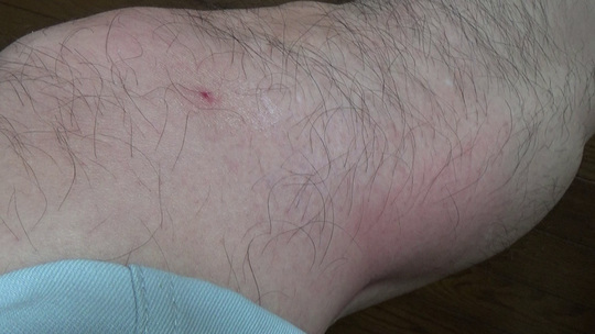 スズメバチに刺されて３時間後の傷跡